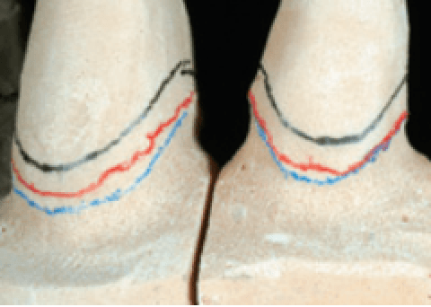 Biologically oriented preparation technique (BOPT): a new approach for prosthetic restoration of periodontically healthy teeth