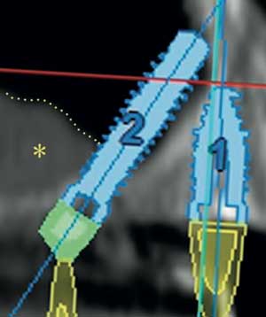 Nuove possibilità per la riabilitazione dei mascellari con estesa pneumatizzazione dei seni mascellari