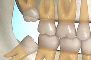 PERCHE I DENTI NON POSSONO E NON DEVONO RESTARE FERMI E ALLINEATI TUTTA LA VITA?