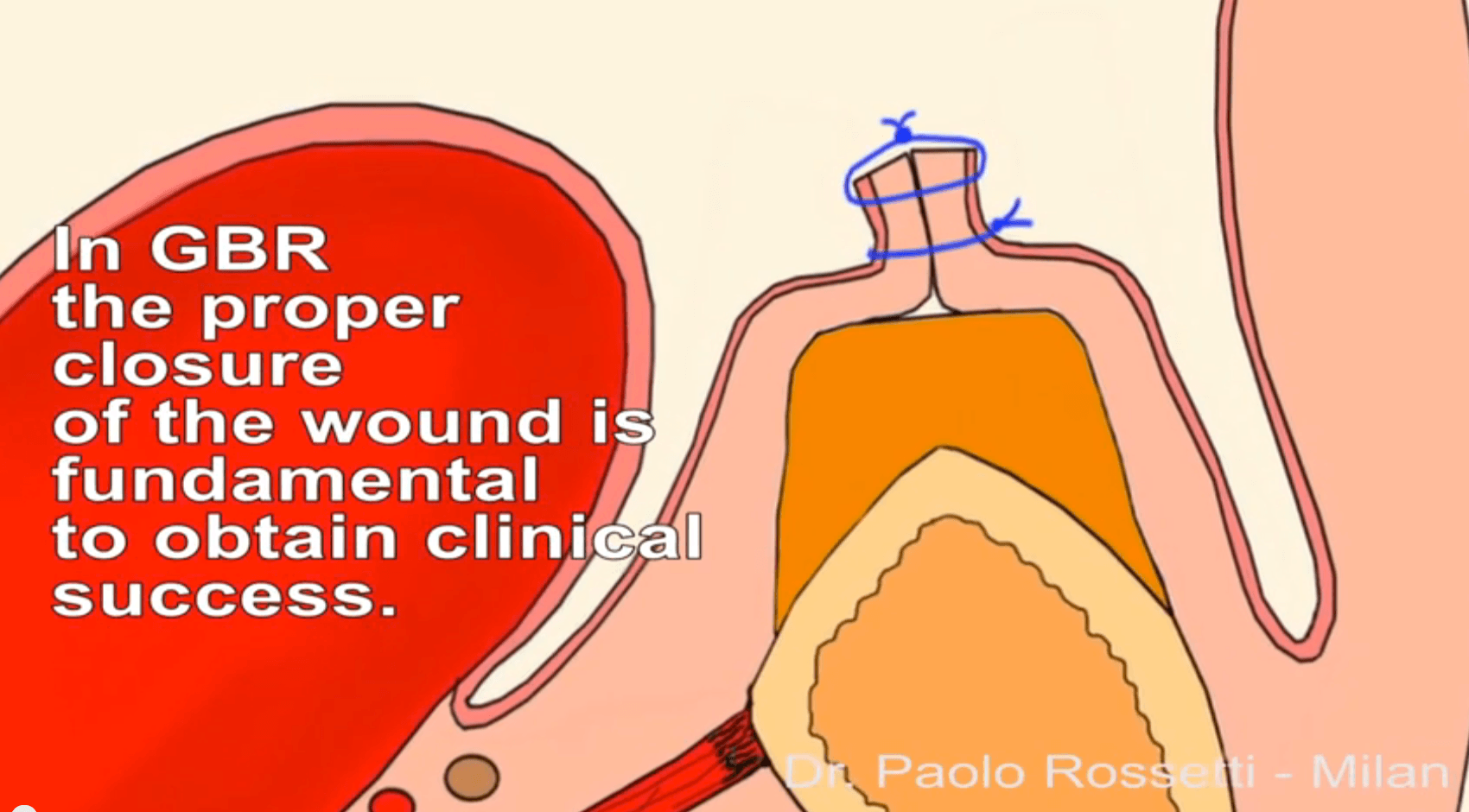 Suture in Guided Bone Regeneration