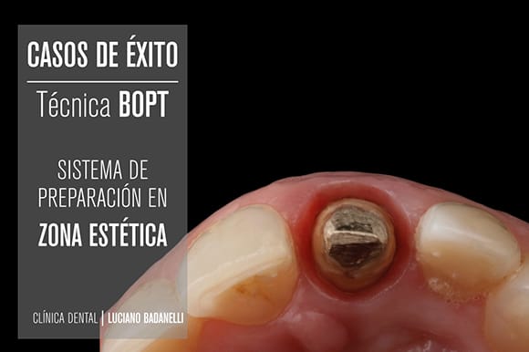 Trattamento con BOPT, tecnica di preparazione del dente.