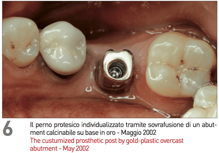 Trattamento di mono edentulia mandibolare con semplice tecnica chirurgica di base