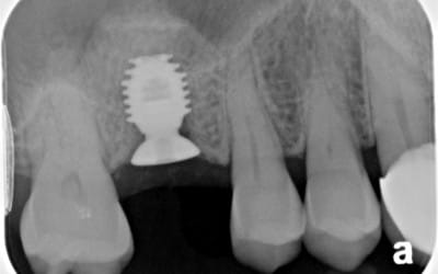 Impianti dentali e settore merceologico