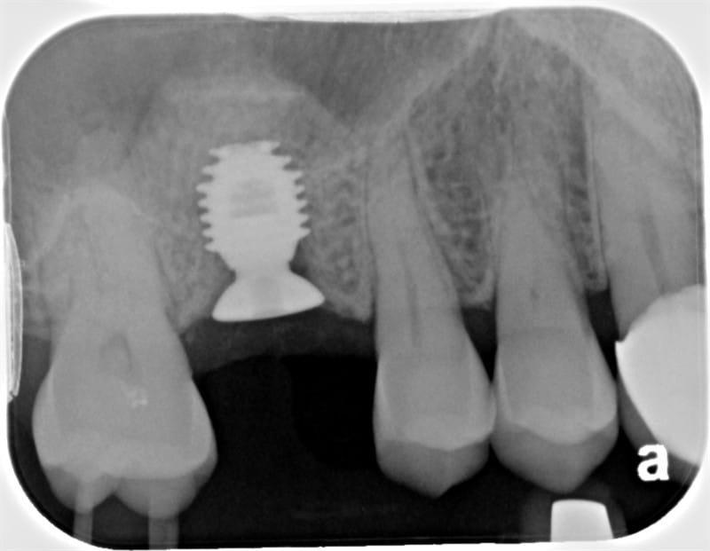 Impianti dentali e settore merceologico