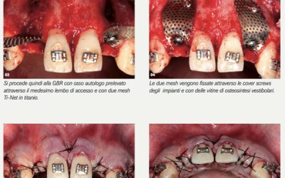 Trattamento implantologico delle creste sottili: Split Crest o GBR?