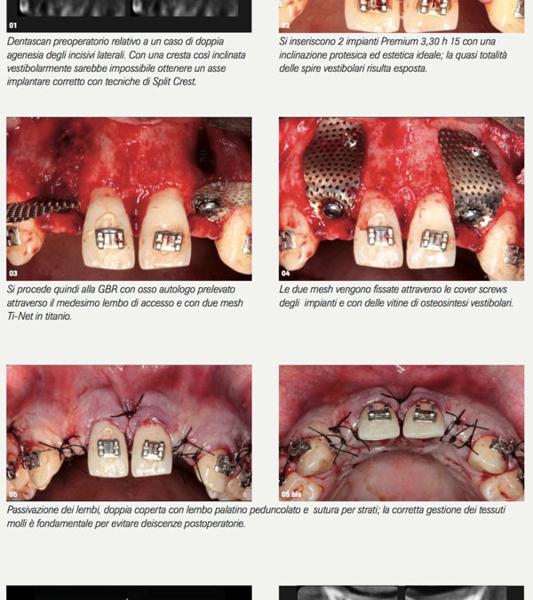 Trattamento implantologico delle creste sottili: Split Crest o GBR?