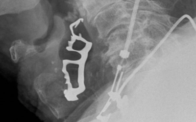 Prevenzione delle ingestioni accidentali della componentistica implanto-protesica