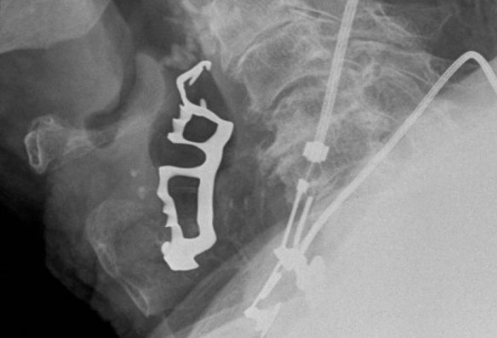 Prevenzione delle ingestioni accidentali della componentistica implanto-protesica