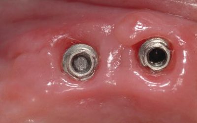 Lo svitamento delle viti implantari è stato riconosciuto come la più frequente problematica meccanica implantare