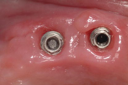 Lo svitamento delle viti implantari è stato riconosciuto come la più frequente problematica meccanica implantare