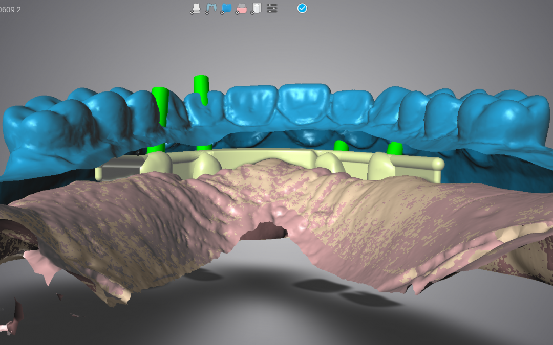 Barra fresata su basi IPD • Laboratorio New Dental Generation