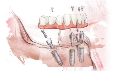 MultiUnit per tecnica di Malo anche da 45° e 60°