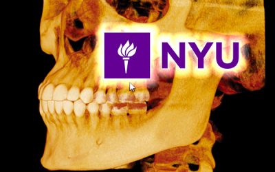 NYU – Predicibilità dei piani di trattamento in implantologia tramite Chirurgia guidata su base modello