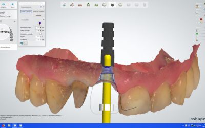 Flussi transprocedurali in settori altamente estetici, il centrale superiore nel paziente complesso.