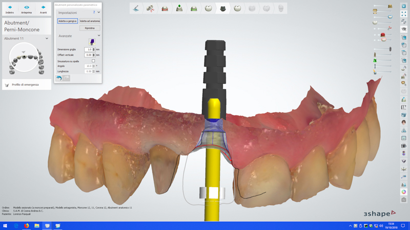 Flussi transprocedurali in settori altamente estetici, il centrale superiore nel paziente complesso.